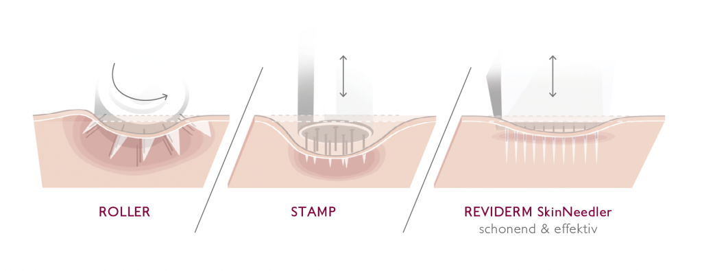 Microneedling 