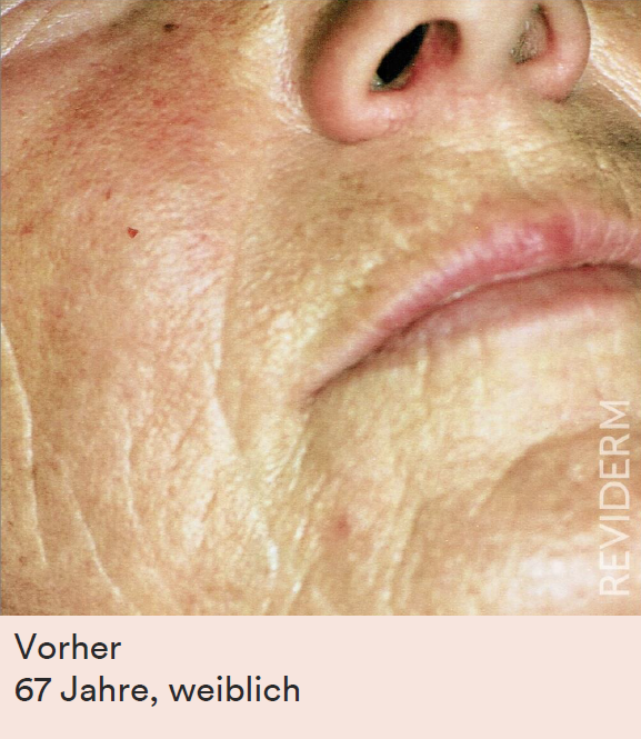 Reliefverfeinerung vorher