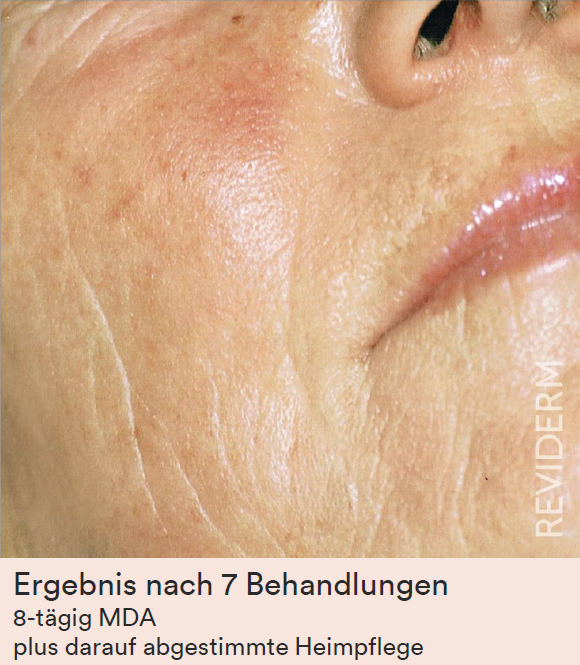 Reliefverfeinerung nachher